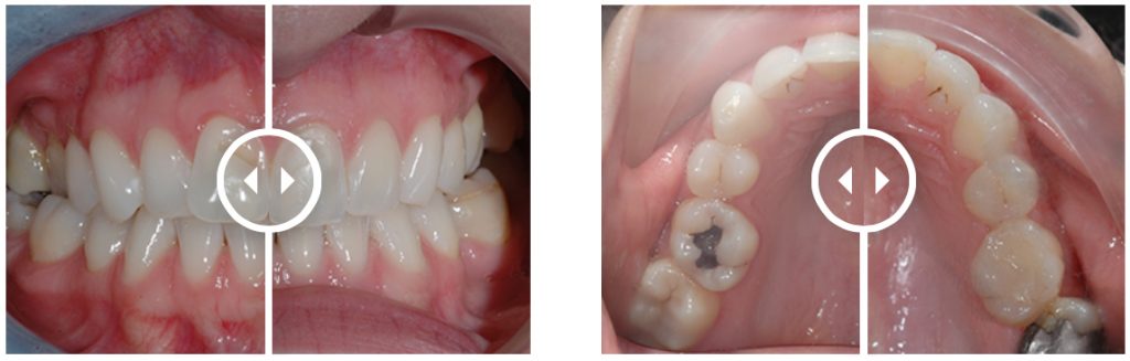 Orthodontic Aligners treatment before and after. Treatment time: 4,5 months
