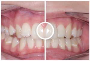 dental-lab-medimatch-orthodontic-aligners-before-after