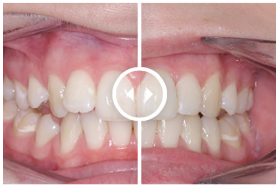 Orthodontic Aligners treatment before and after. Treatment time: 3 months
