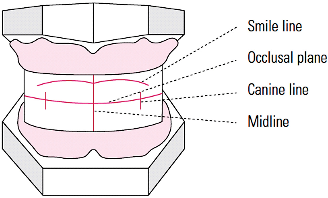 Recording a Bite Registration for the Edentulous Patient MediMatch