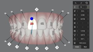 Clear Aligners - Image 3