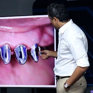 telescopic-dentures-course-dr-pedram-negahban